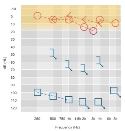 Air conduction thresholds for determining Baha candidacy