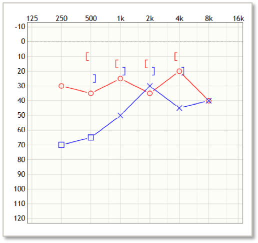 Roy's audiogram