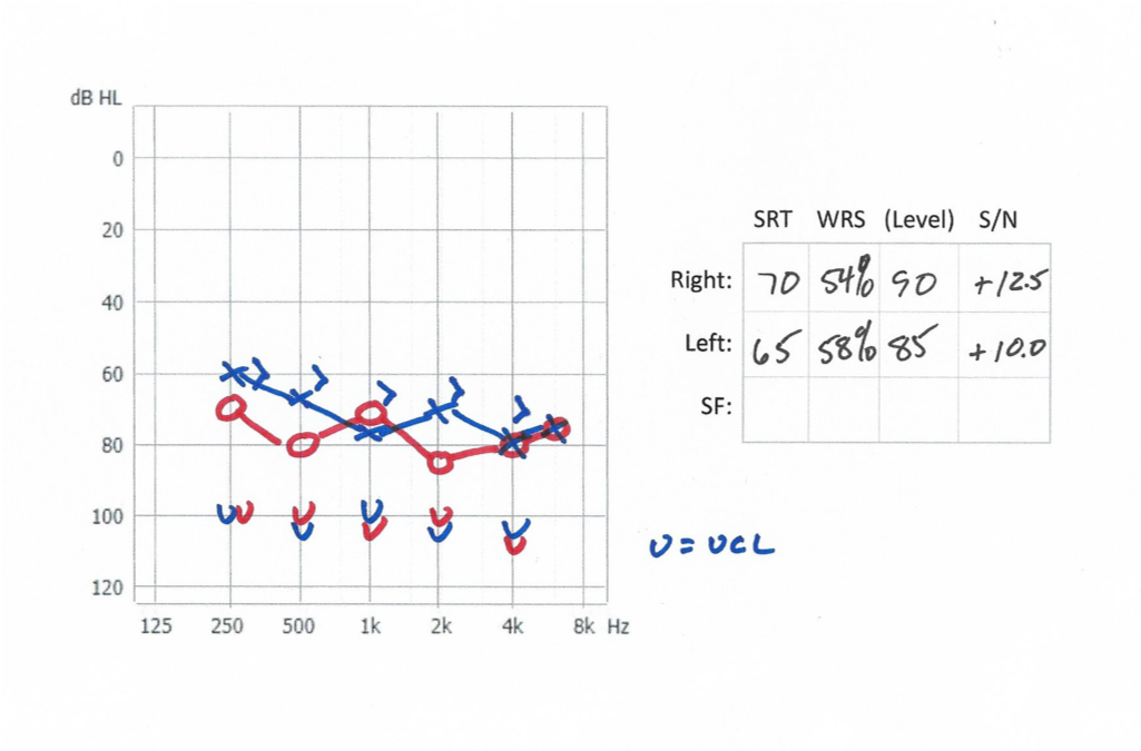 Audiogram of severe hearing loss right and left - case 1