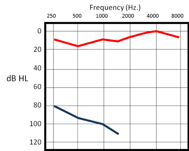 Audiogram of severe-profound hearing loss left and normal hearing right - case 2