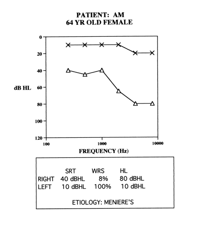 Audiogram of moderate-severe hearing right and normal hearing left - case 3