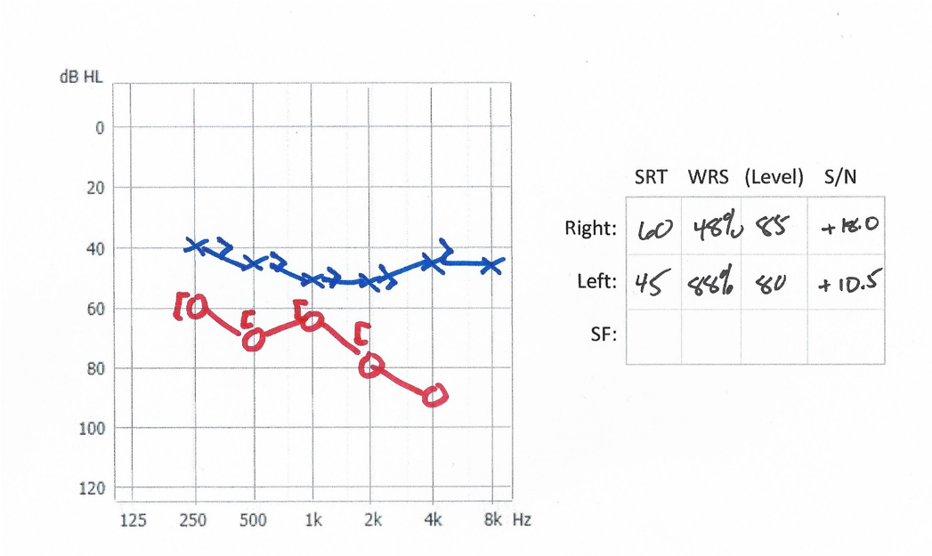 Audiogram of mild-moderate hearing loss left and moderate-severe hearing loss right - case 4