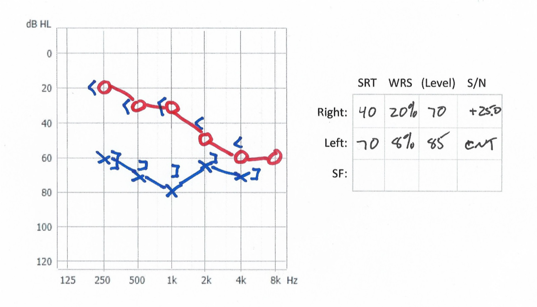 Audiogram of mild to moderate hearing loss right and moderate-severe hearing loss left - case 5