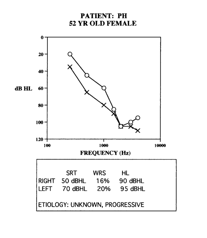 Audiogram of mild to profound hearing loss right and left - case 6