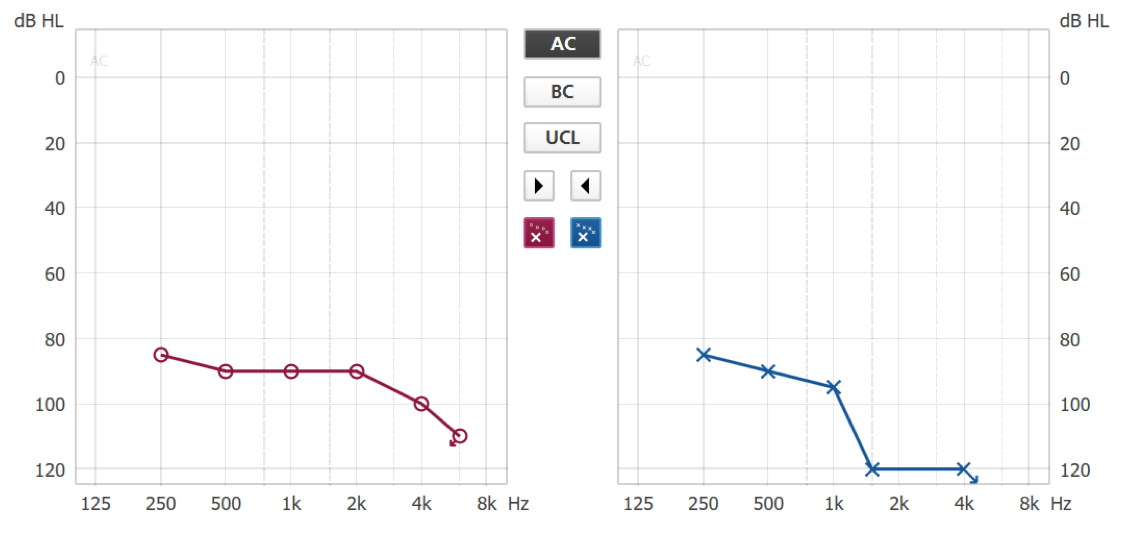 Audiogram of severe to profound hearing loss for both the right and left ears