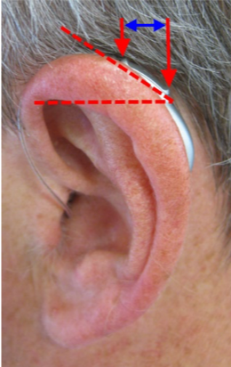 The tilt angle caused by a device placement behind the ear, and the impact on the effective distance between the front and rear microphones