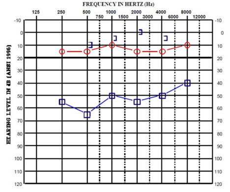 Audiogram for case study A