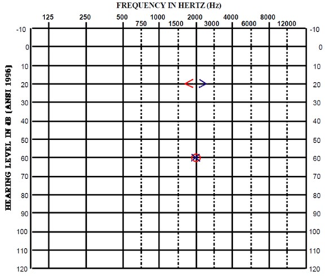 Audiogram for case study B