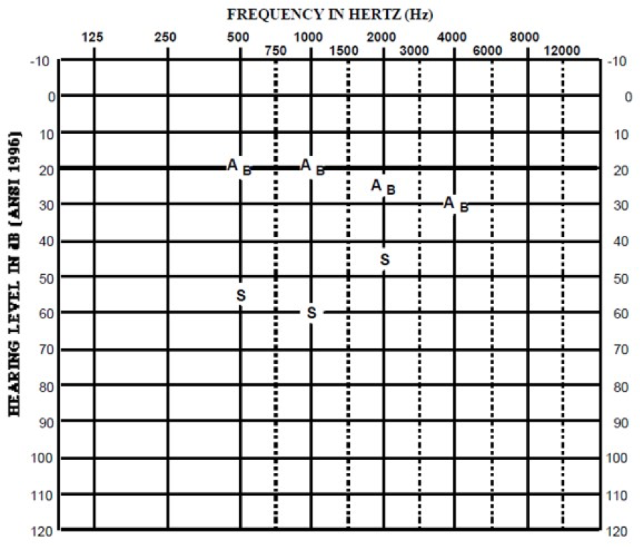 Follow-up audiogram for case study B