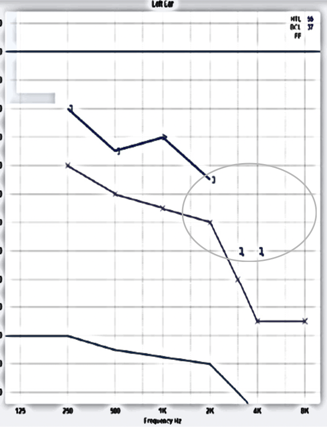 Case 1's audiogram