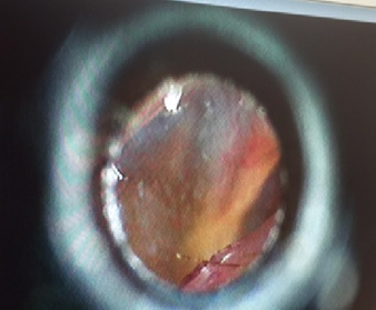 An example of an abrasion Case 4