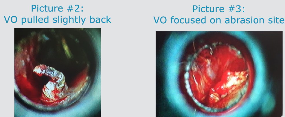 Other views of the abrasion in Case 4