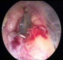 A post-cerumenectomy with a small hematoma and contusion with bleeding