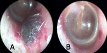 Sizeable AD subdermal hematoma 24 hours and one month after cerumen removal