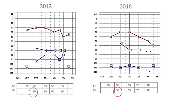 Example of under masking at 30dB-EM