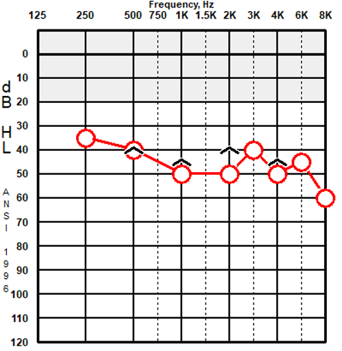right ear audiogram showing mild to moderate sensorineural hearing loss