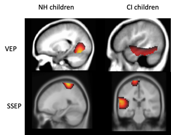 EEG source analysis via current density source reconstruction (CDR) showing sources of cortical activity in children with normal hearing and children with cochlear implants as described in the caption to figure 5.