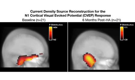 Current density source reconstruction for the N1 cortical visual evoked potential (CVEP) response at baseline and 6 months post hearing aid use as described in figure 6 caption.