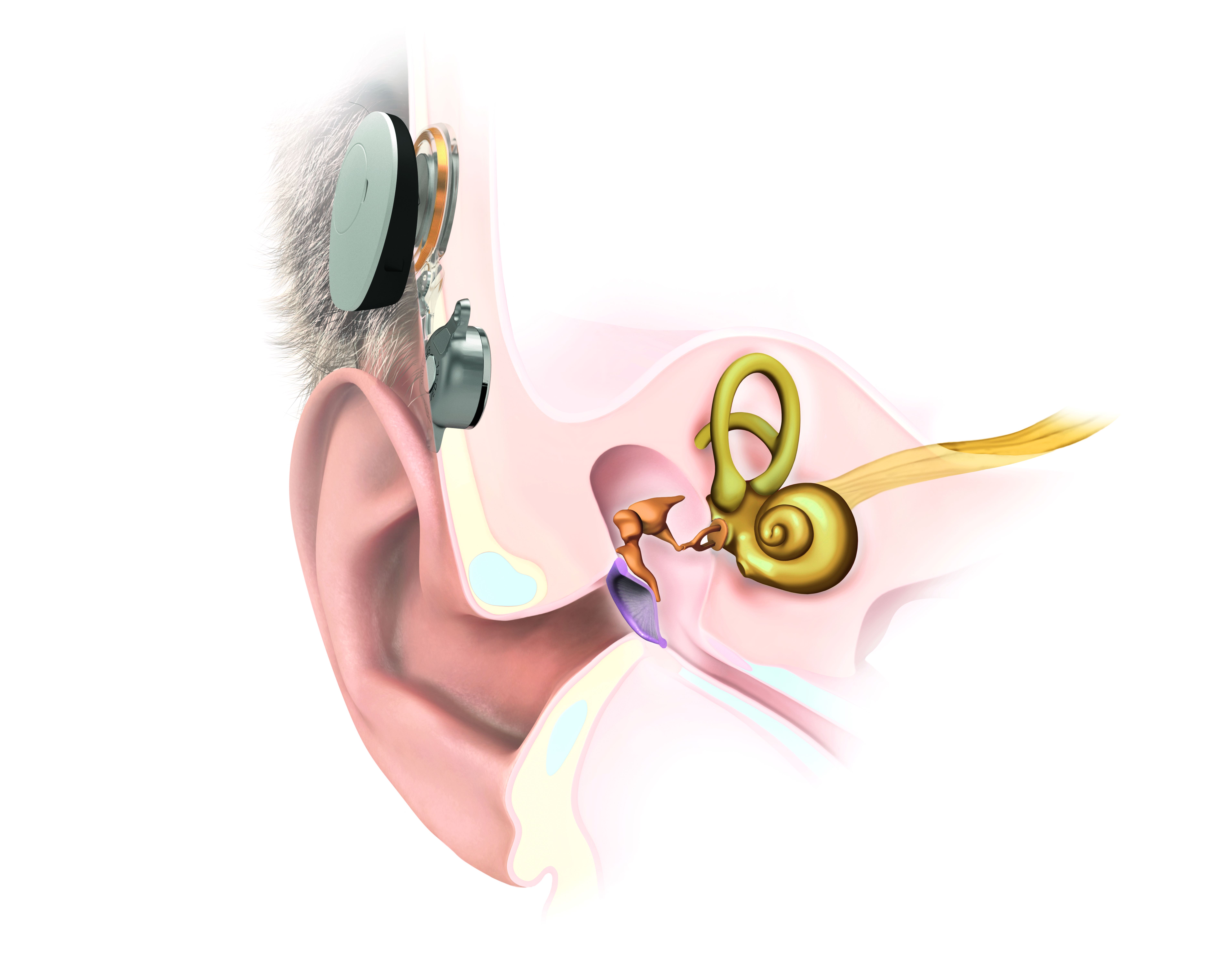 image of bone conduction implant placement and parts of the ear