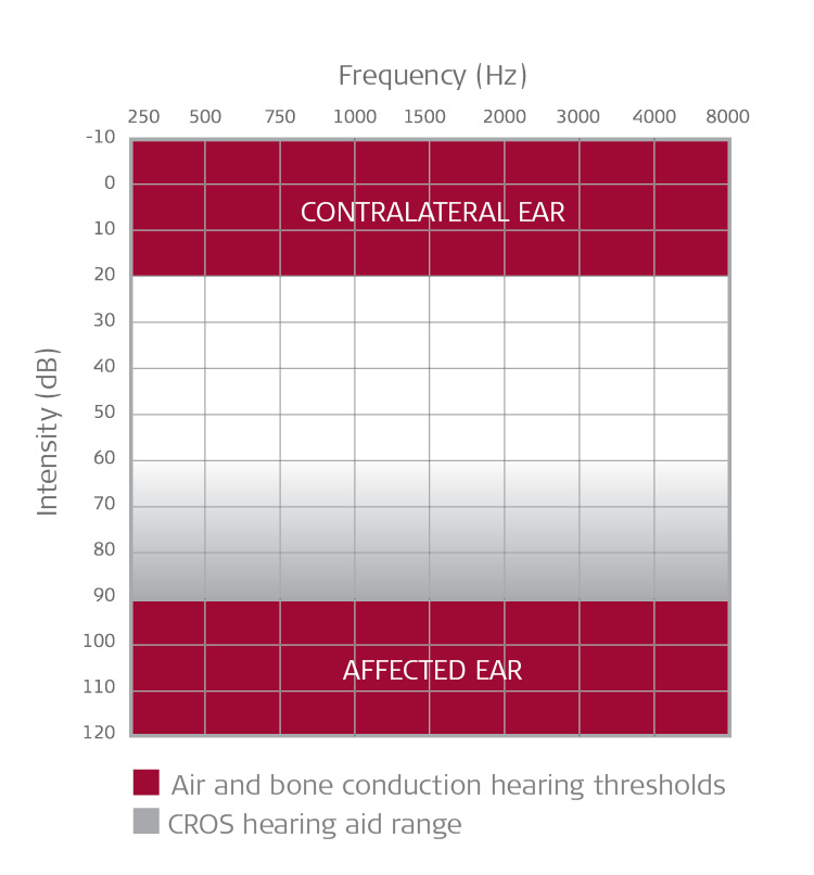 candidacy air and bone conduction thresholds for single sided deafness.