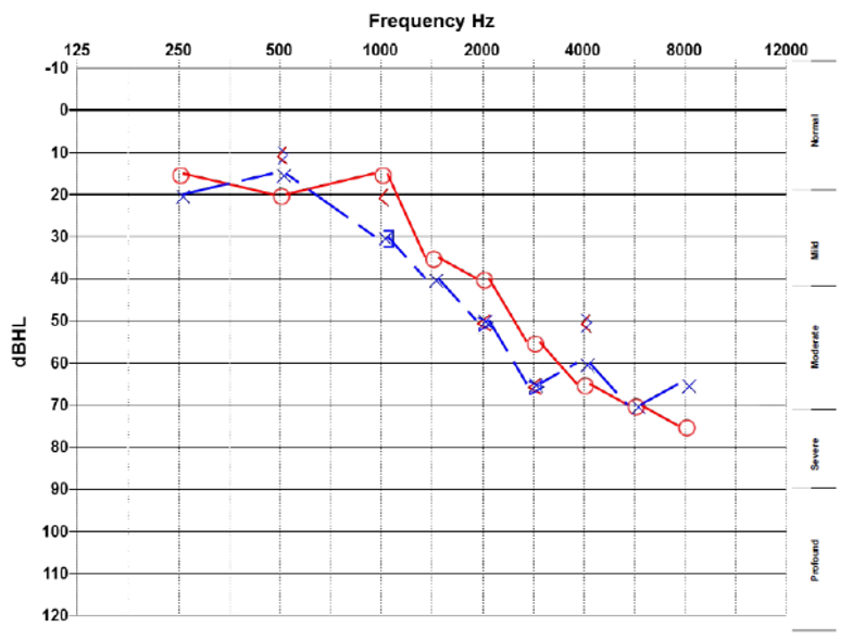 audiogram showing normal hearing in the low frequencies sloping to severe sensorineural hearing loss in the high frequencies bilaterally.