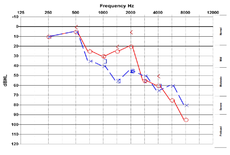 audiogram showing normal low frequency hearing steeply sloping to severe sensorineural hearing loss, with noted asymmetry between ears at 1500 - 2000 Hz.