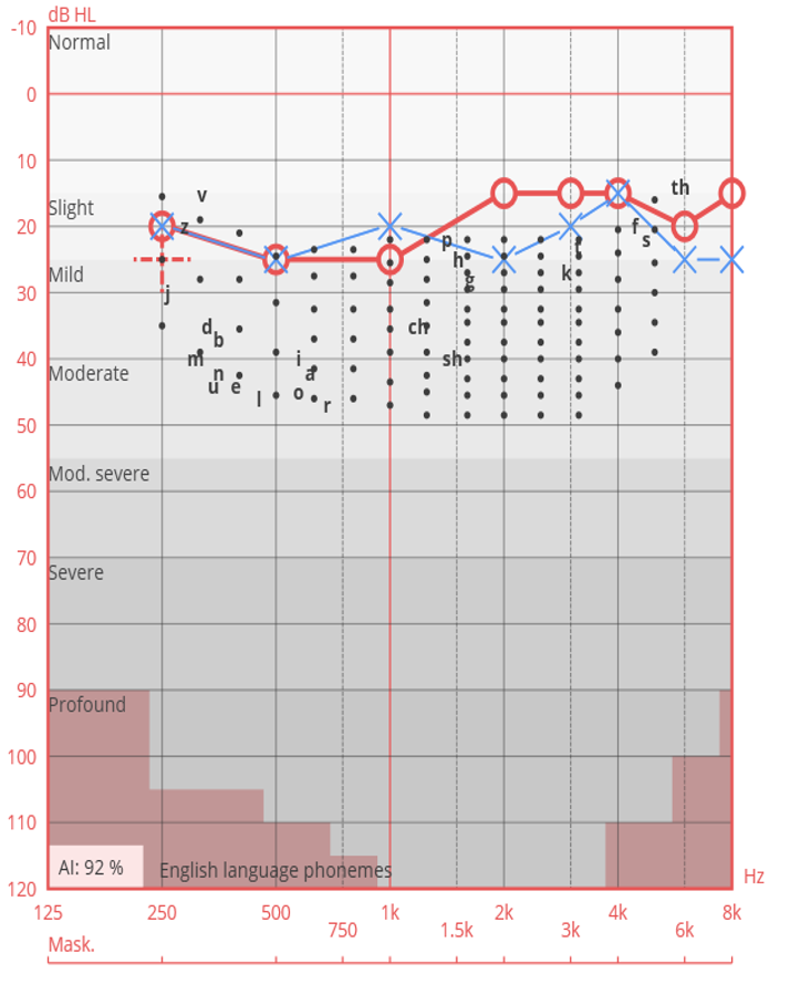 Extensamente níquel Patria When is Ultra High-Frequency Audiometry Clinically Useful?