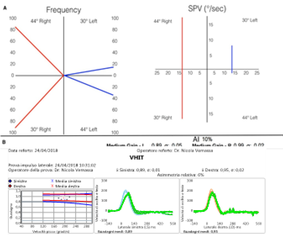 Results of caloric test and vHIT