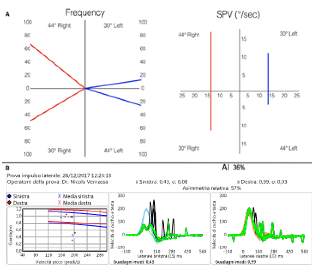 Results of caloric and vHIT